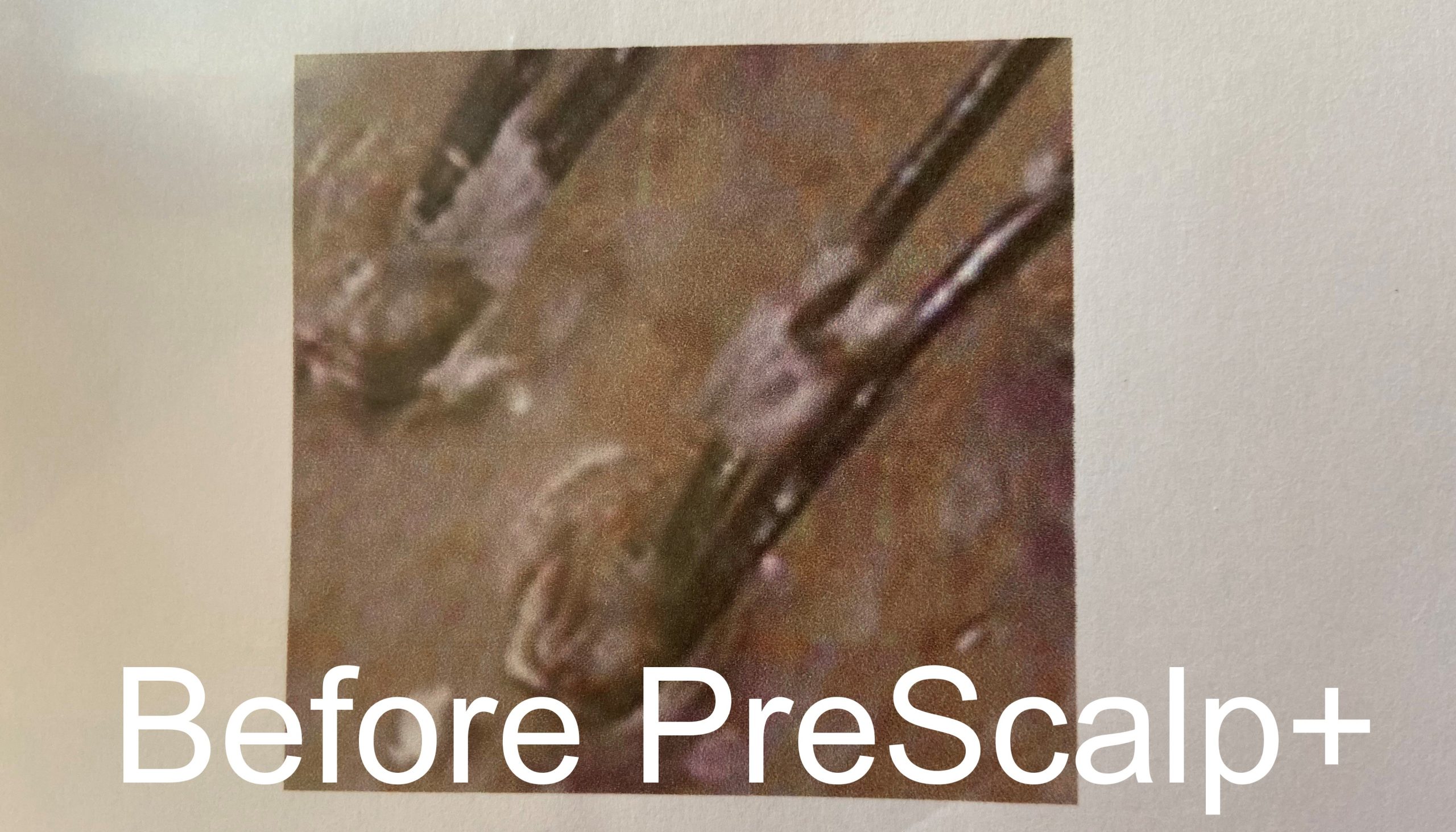 PreScalp+™ - Image 5